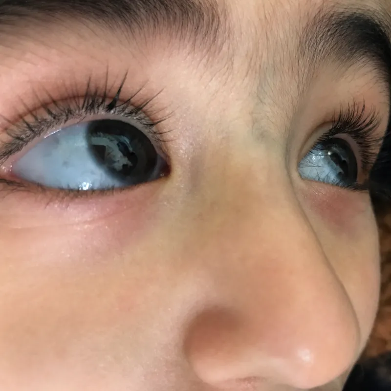 Blue sclera in a child