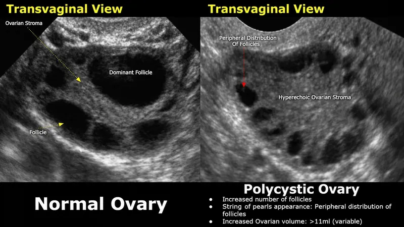 PCOS Ultrasound: Normal vs. Polycystic Ovary