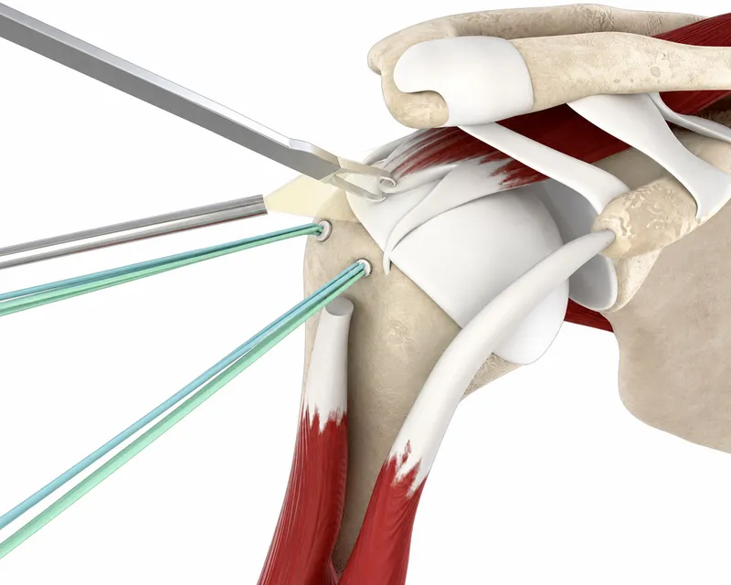 Arthroscopic Rotator Cuff Repair Technique