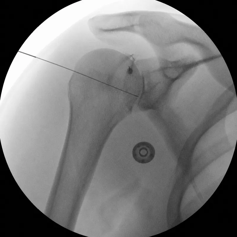 Glenohumeral joint injection under fluoroscopy