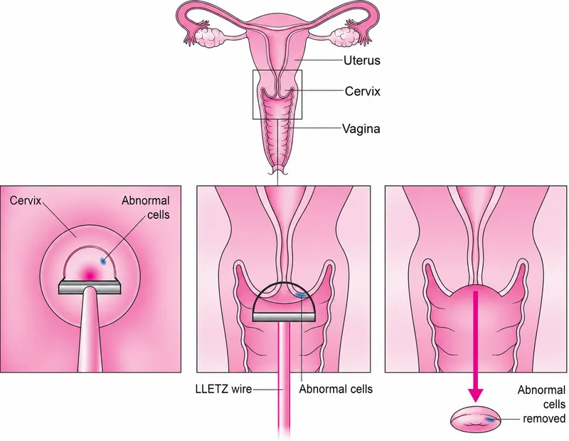 LEEP procedure diagram