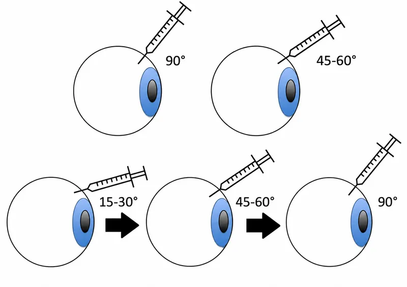 Intravitreal injection angles and technique
