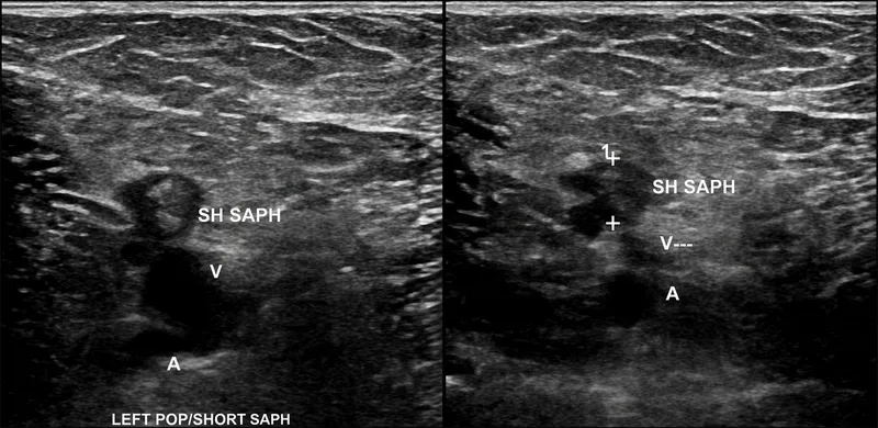 Ultrasound of non-compressible popliteal vein (DVT)