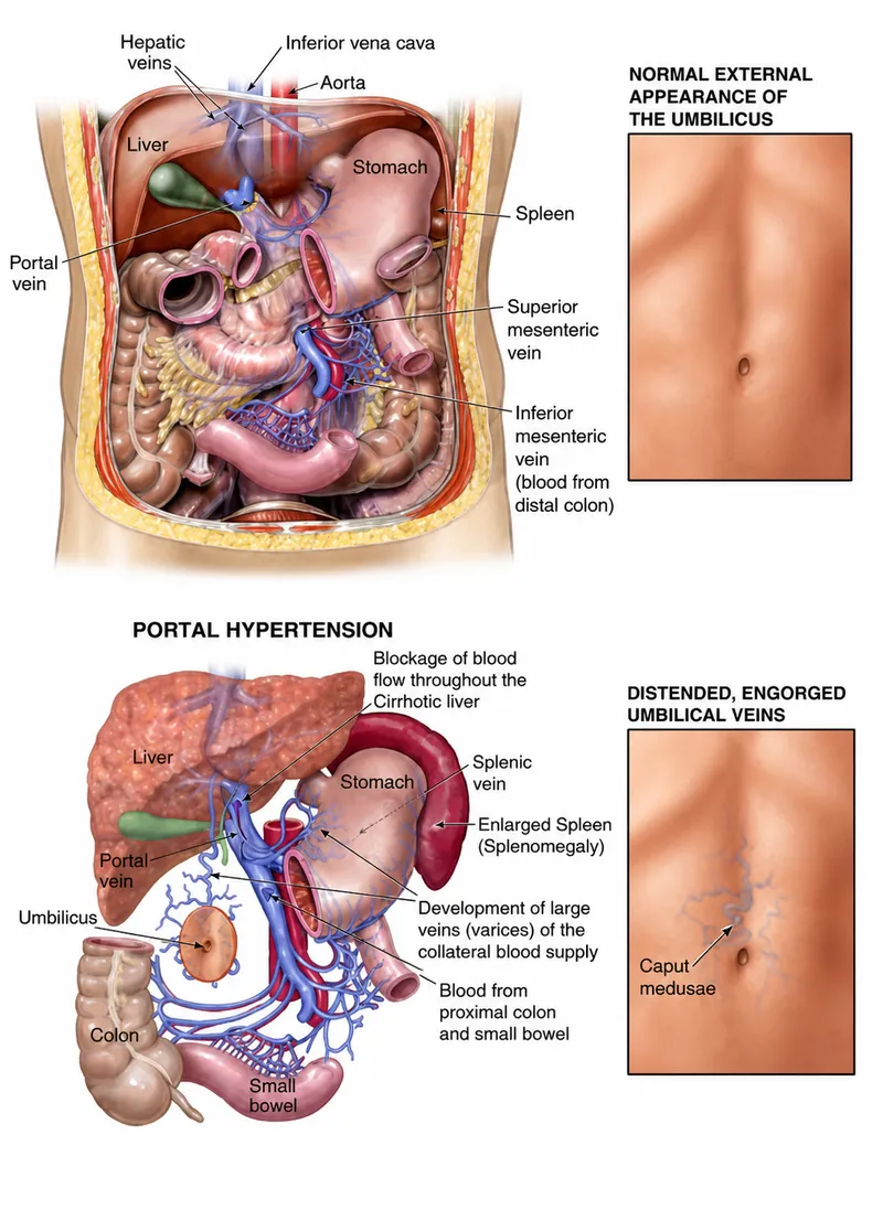 Portal Hypertension and Caput Medusae
