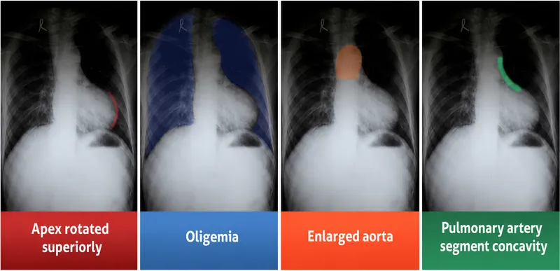 Tetralogy of Fallot: Boot-shaped heart on chest X-ray