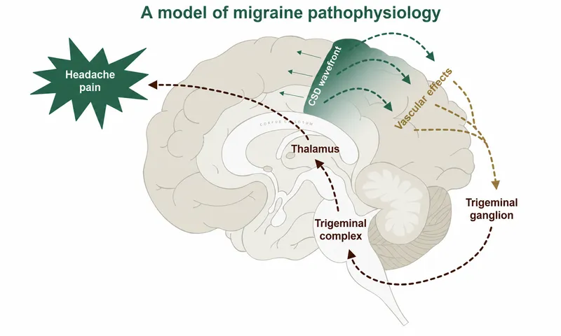Migraine Pathophysiology: Cortical Spreading Depression