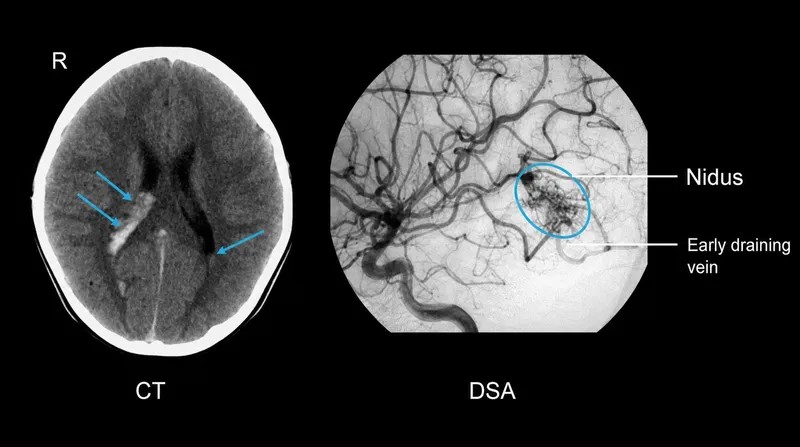 DSA of cerebral AVM nidus and early draining vein