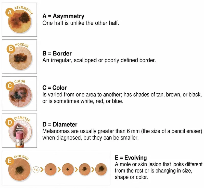 ABCDEs of Melanoma