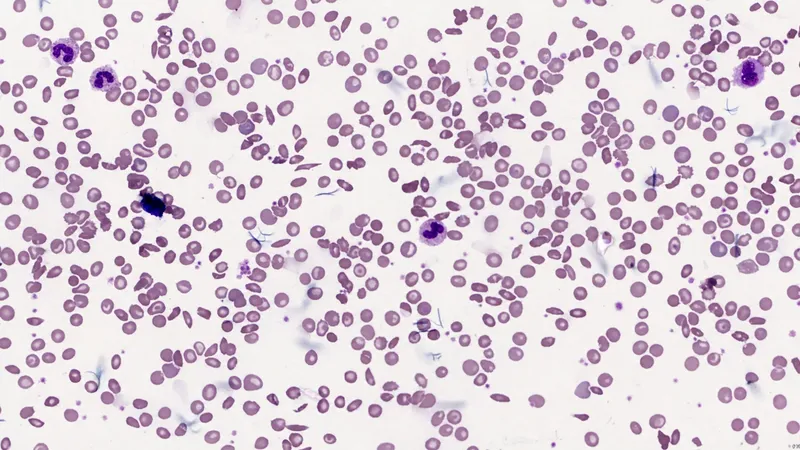 Peripheral blood smear with sickle and target cells