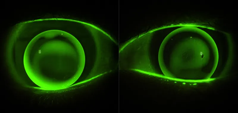 RGP lens fluorescein: ideal vs steep fit