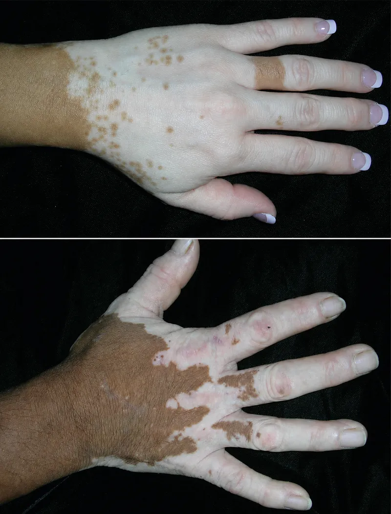 Vitiligo on hands showing depigmented patches