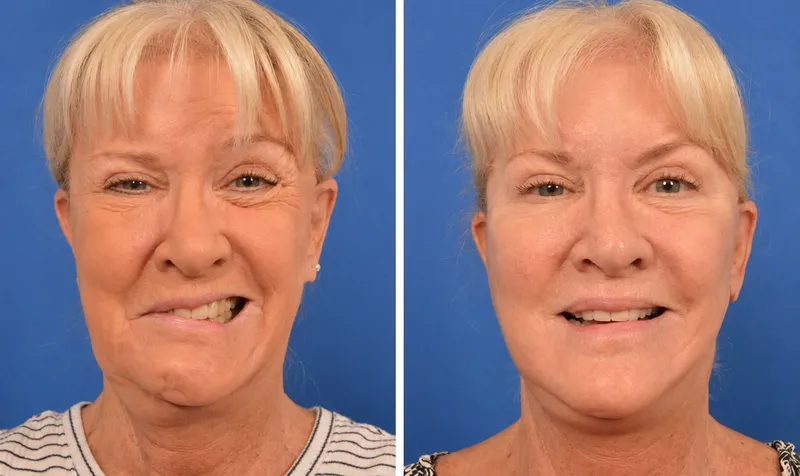 Facial Reanimation Before and After