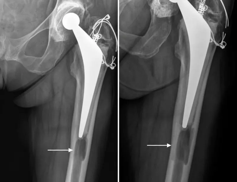 Periprosthetic osteolysis on X-ray around hip arthroplasty