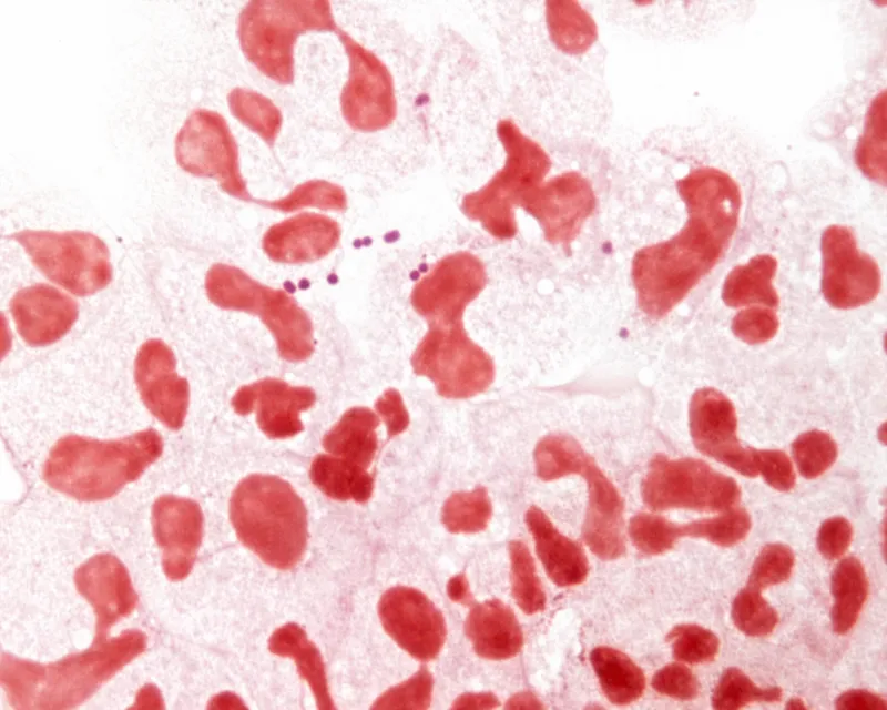 Gram stain of CSF showing Neisseria meningitidis