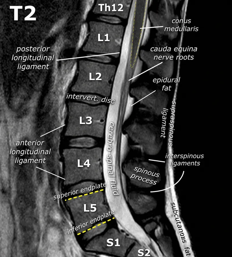 Detailed sagittal spine MRI showing normal vertebral alignment and disc spaces
