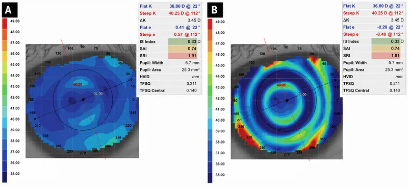 Corneal Topography: Axial and Tangential Maps
