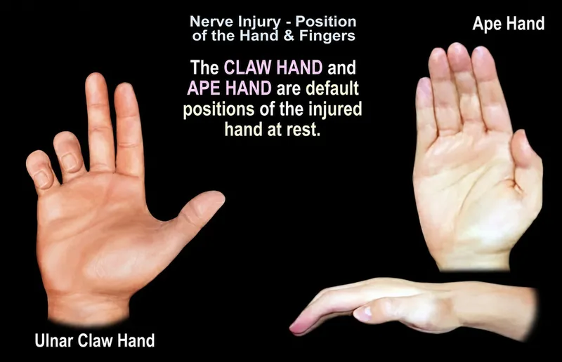 Ulnar Claw Hand and Ape Hand from Nerve Injury