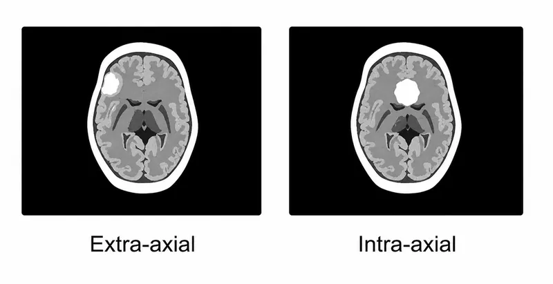 Intra-axial vs Extra-axial Tumor Locations
