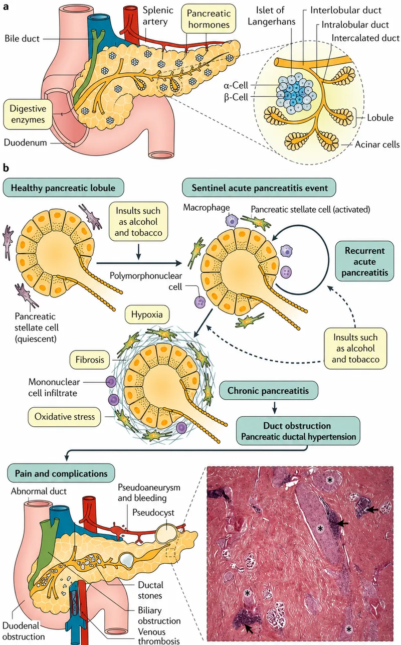 Chronic Pancreatitis Pathophysiology