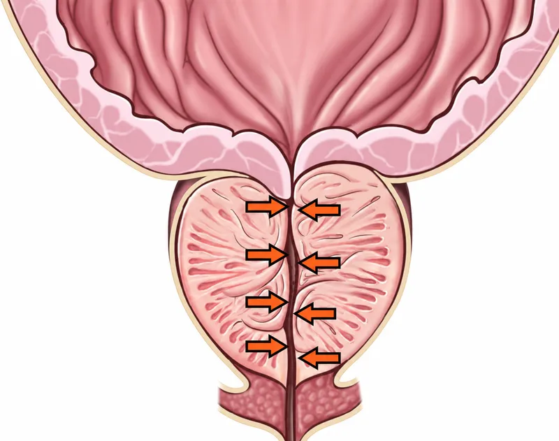 Bladder outlet obstruction from benign prostatic hyperplasia