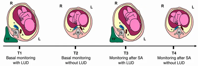 Aortocaval compression and left uterine displacement