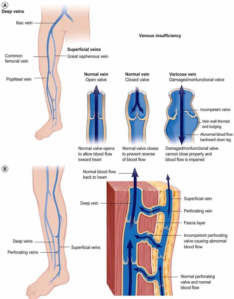 Venous valve incompetence and chronic venous insufficiency