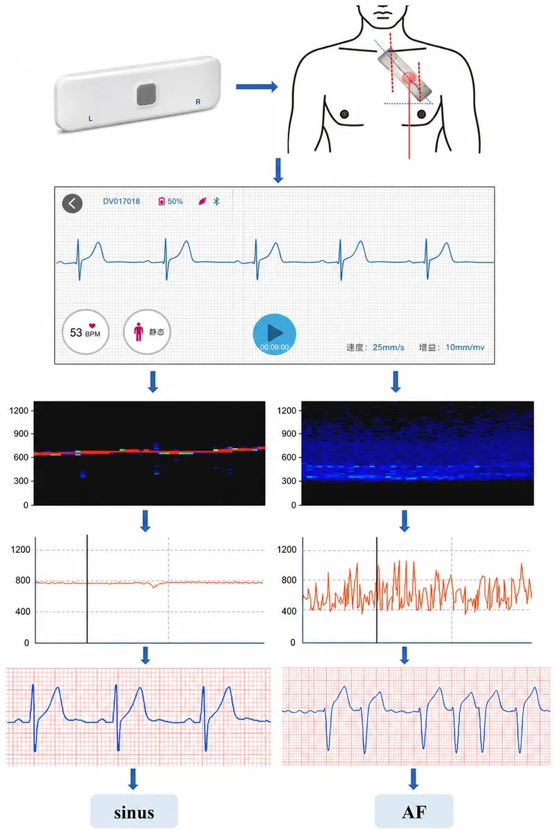 ECG showing sinus rhythm and atrial fibrillation