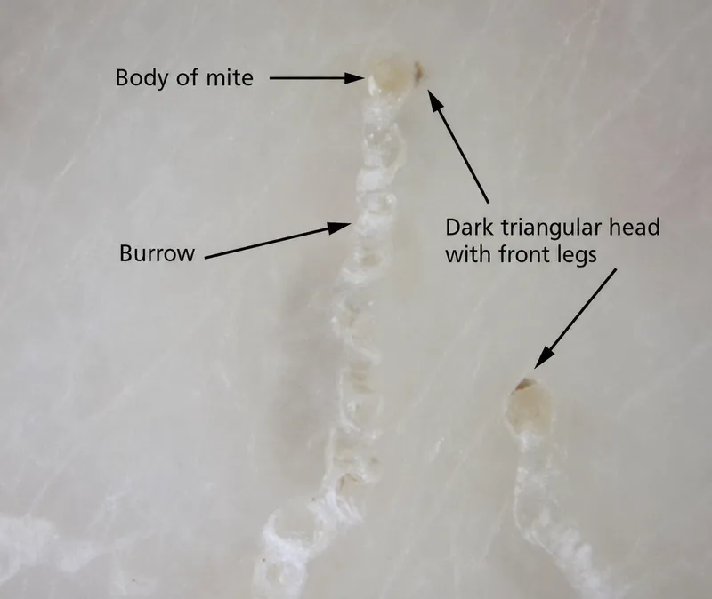 Dermoscopy of scabies mites and burrows