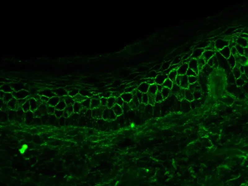 Pemphigus: Direct Immunofluorescence, Chicken-Wire Pattern