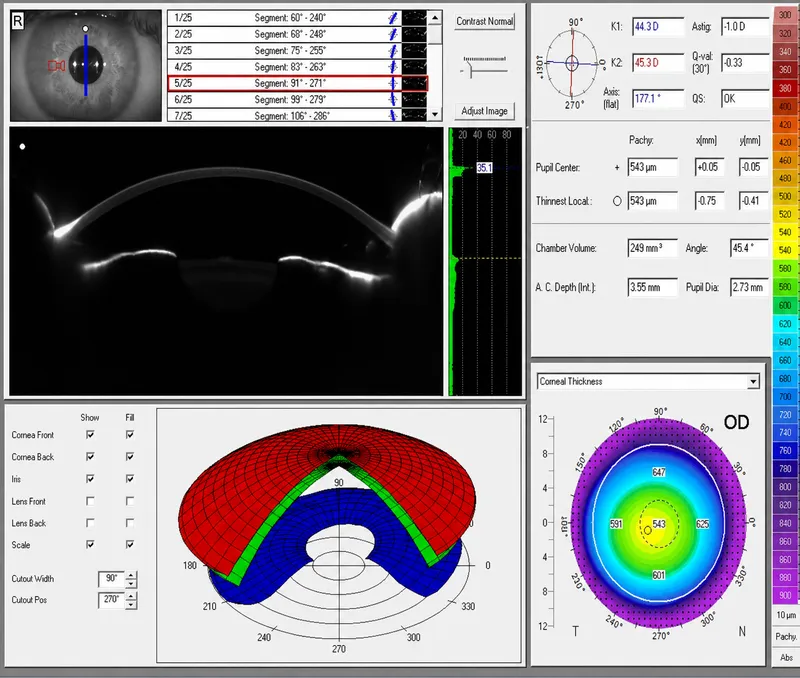 Pentacam Overview: Scheimpflug, 3D Shape, Pachymetry