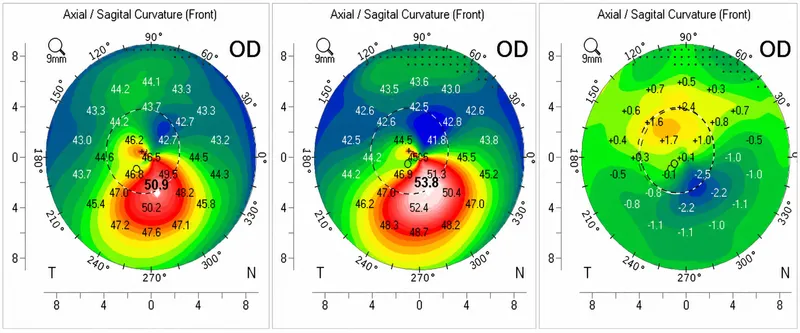 Keratoconus corneal topography maps