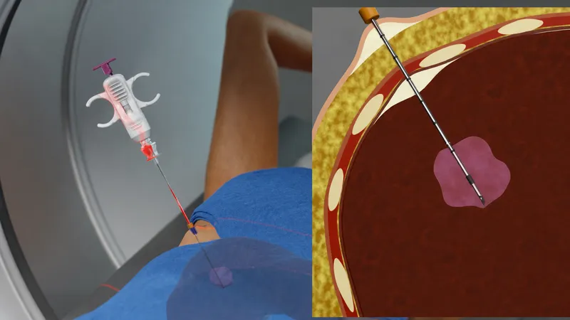 CT-guided core needle biopsy of liver lesion
