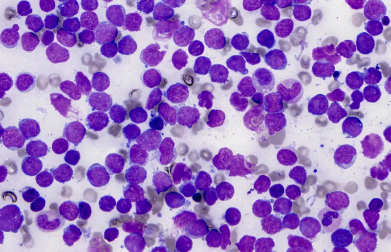 Peripheral blood smear: Lymphoblasts in ALL