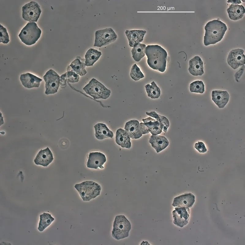 Normal urothelial and squamous cells in urine