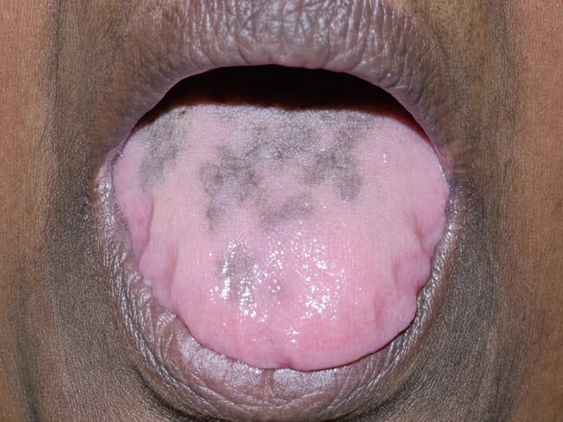 Drug-induced pigmentation of the tongue