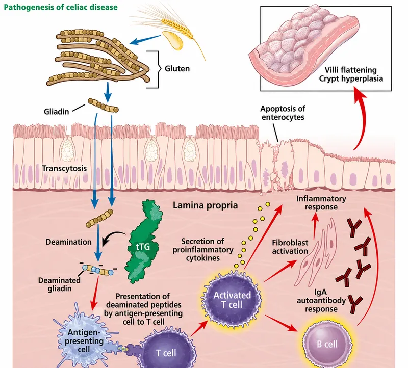 Pathogenesis of Celiac Disease