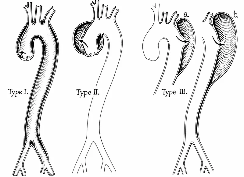 DeBakey Classification of Aortic Dissection