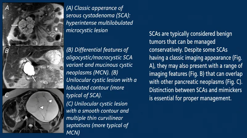 Pancreatic Serous Cystadenoma Imaging and Mimics