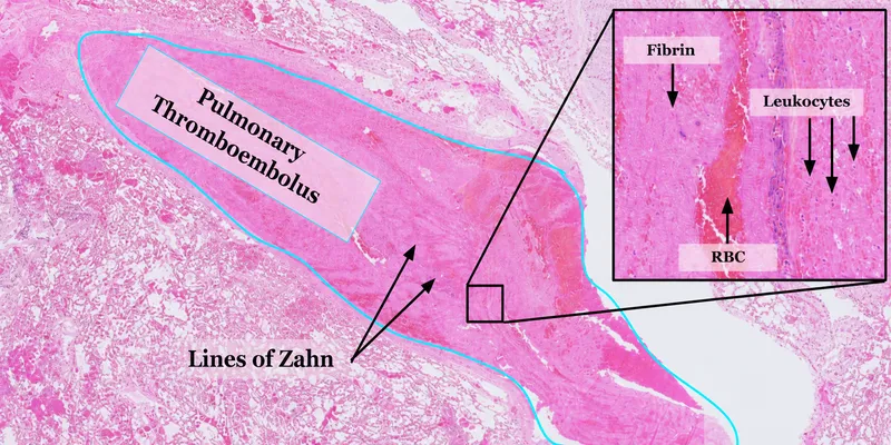 Pulmonary Thromboembolus with Lines of Zahn