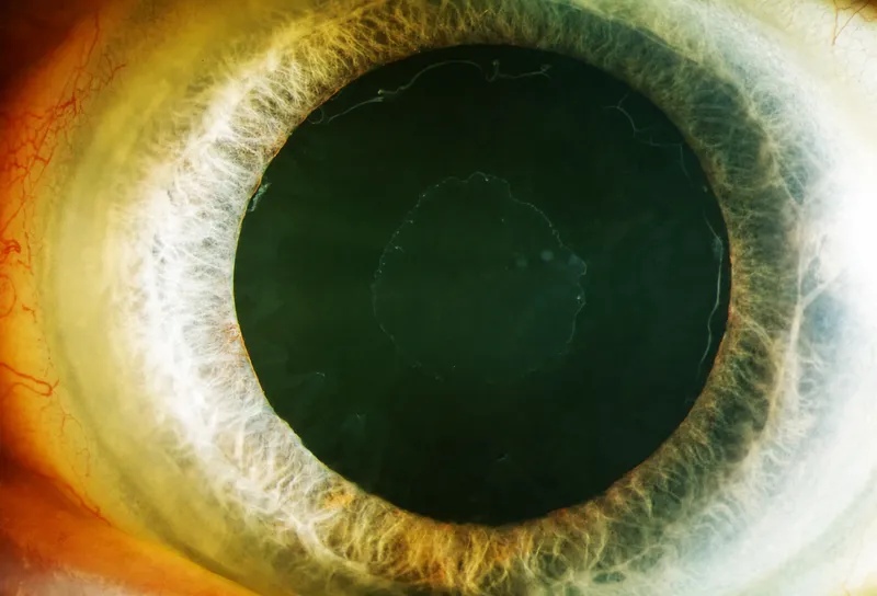 pseudoexfoliation material on lens