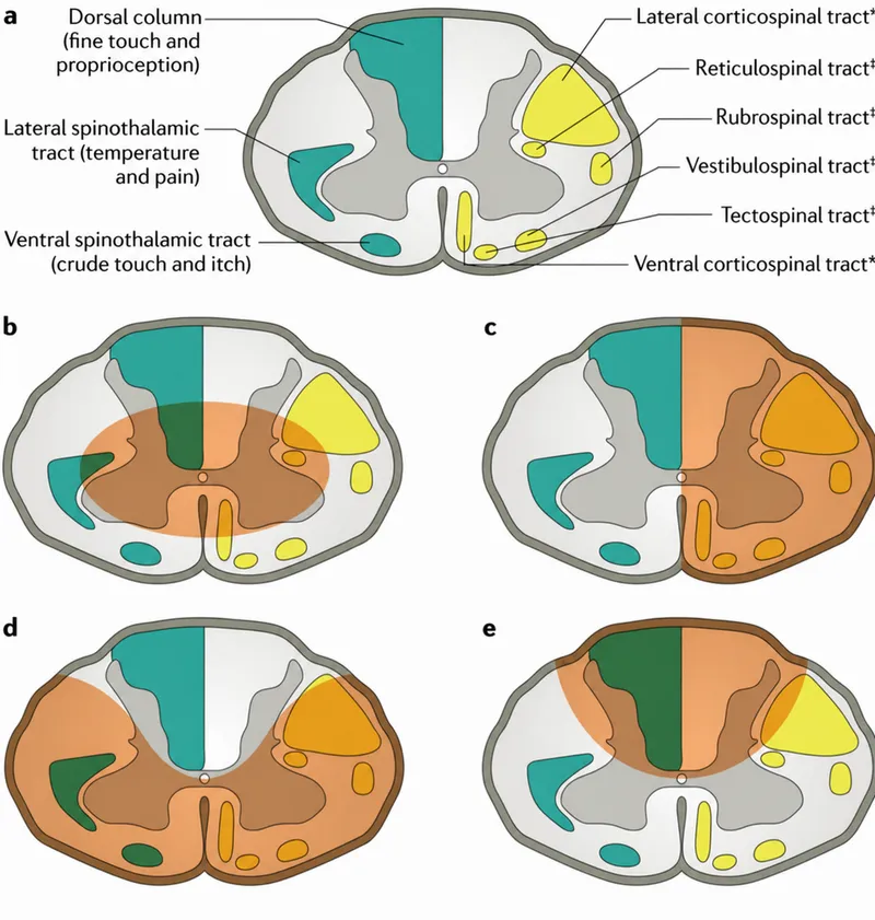 Spinal Cord Tracts and Syndromes