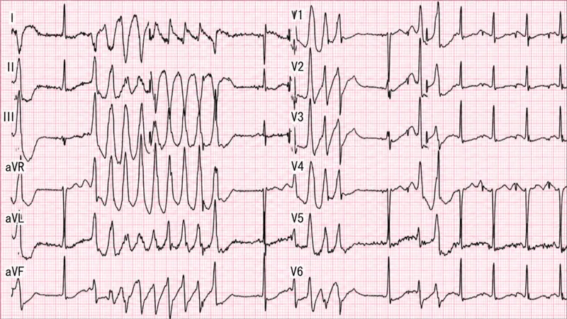 ECG: Torsades de Pointes with polymorphic VT
