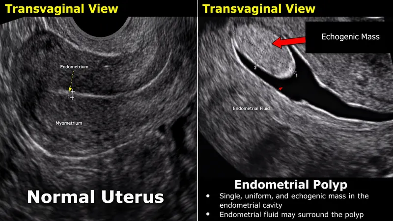 Ultrasound images comparing normal endometrium fibroids polyps and adenomyosis