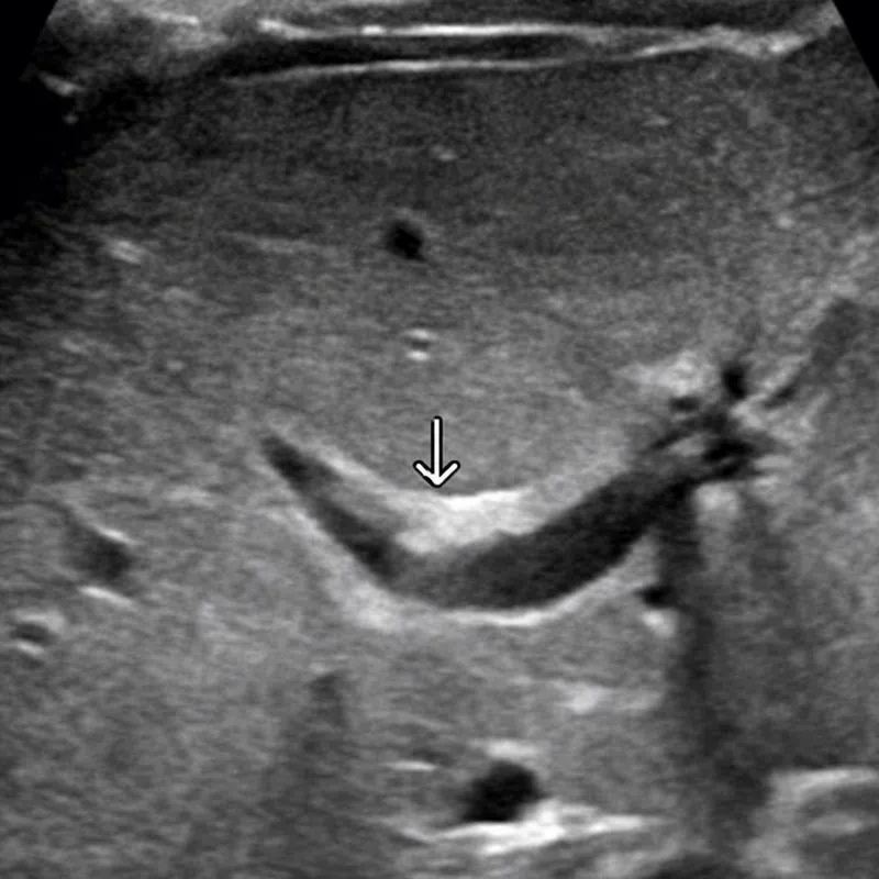 Ultrasound: Triangular cord sign in biliary atresia