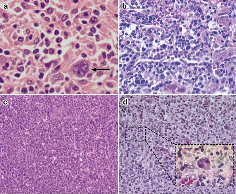 Histology of Post-transplant Lymphoproliferative Disorder