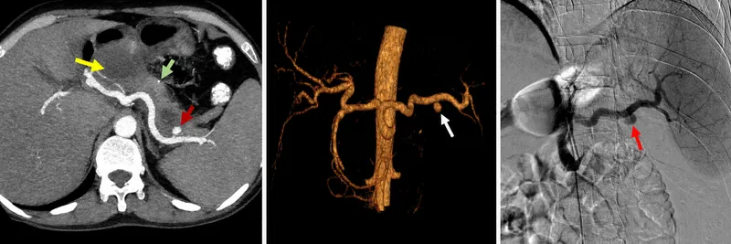 Splenic artery pseudoaneurysm in chronic pancreatitis