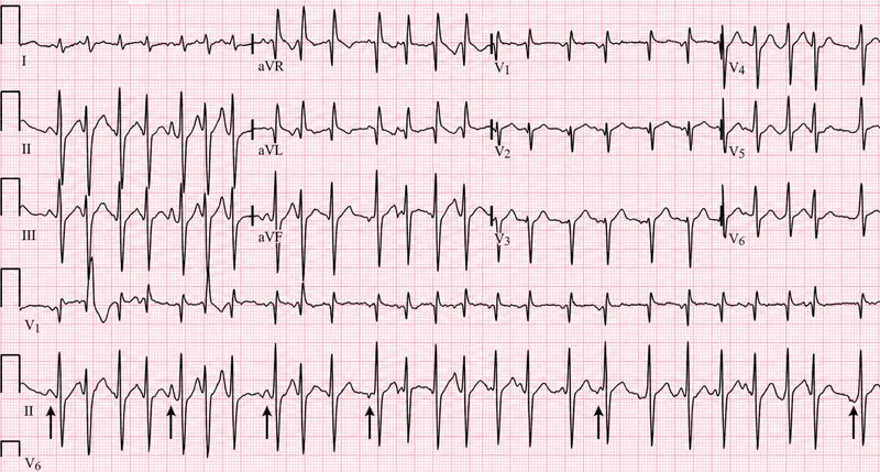 ECG: Multifocal Atrial Tachycardia with P wave variations