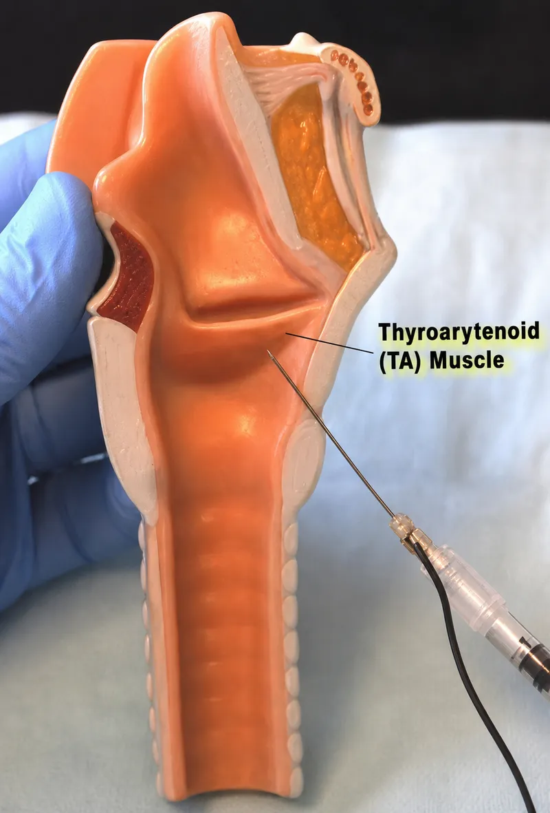 Botox injection into the thyroarytenoid muscle