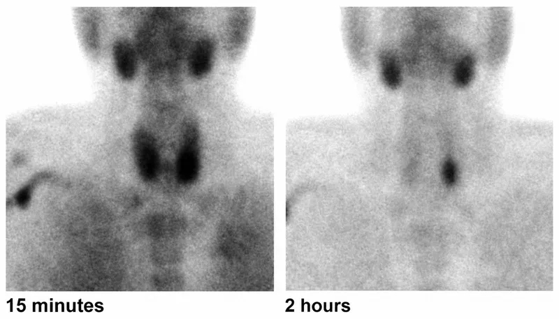 Sestamibi scan showing parathyroid adenoma washout