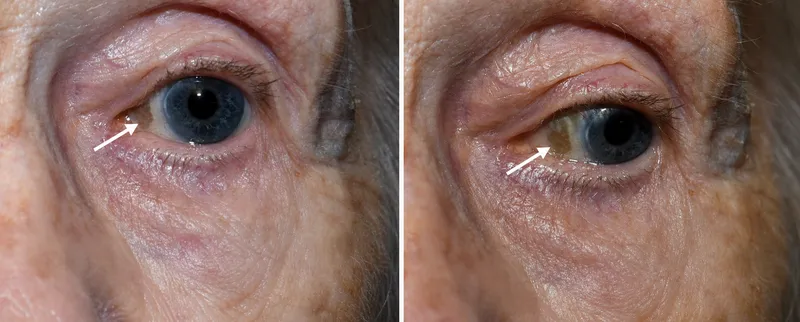 Senile scleral plaque